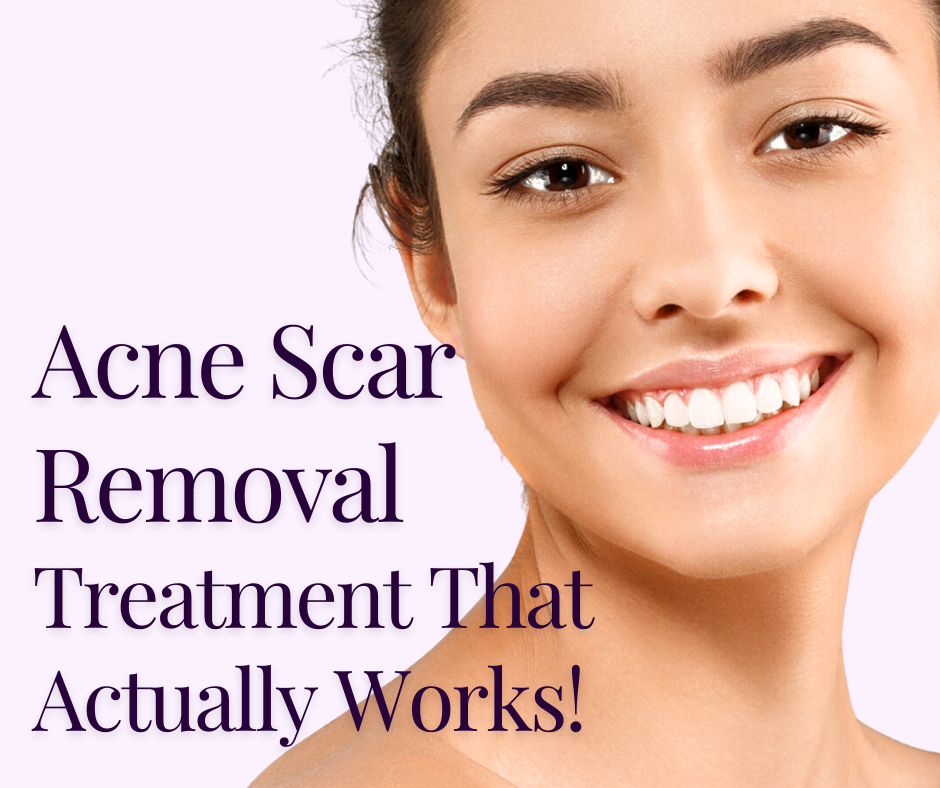 Discover Our Proven Acne Scar Removal Treatment That Actually Works!