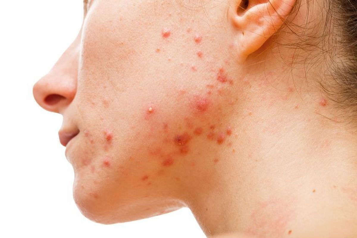 Unlocking Radiant Skin: Your Guide to Adult Acne and Effective Treatments at Klinik Dr Diana