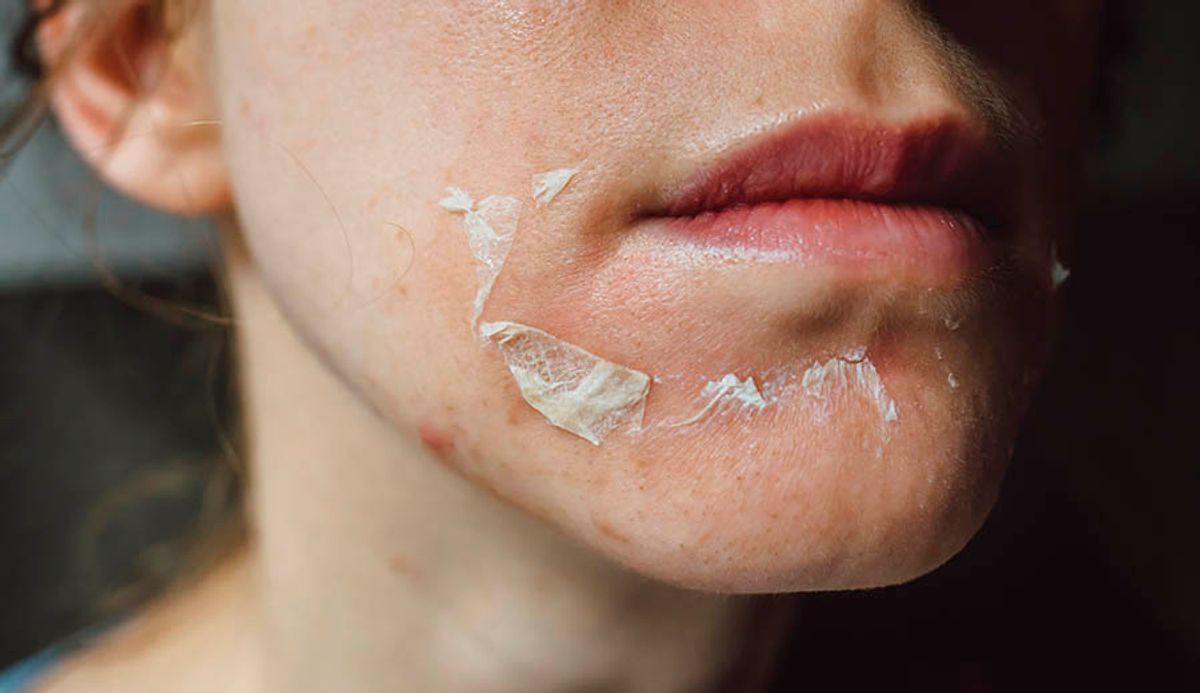 Essential Tips for Post-Chemical Peel Care 