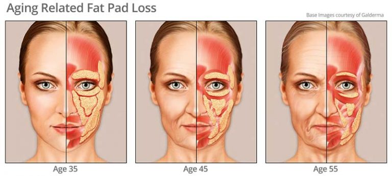 fat-pad-changes-768x346