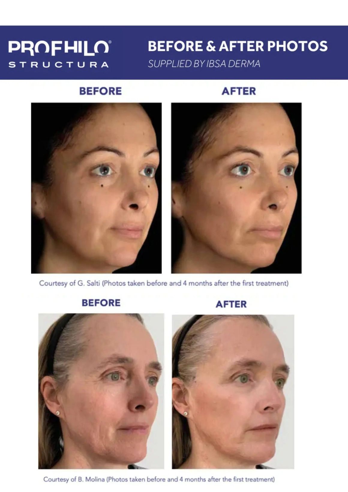 Profhilo-structura klinik drdiana result
