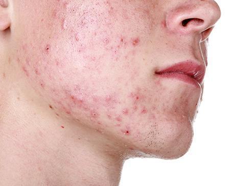 acne.jpg