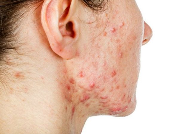 6 Effective Home Remedies For Cystic Acne.jpg