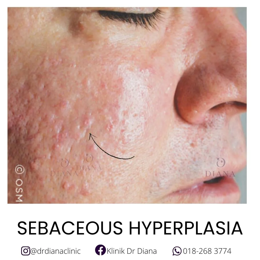 sebaceous glands bumps