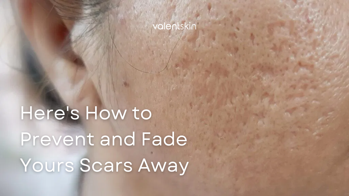 Here's How to Prevent and Fade Your Scars Away