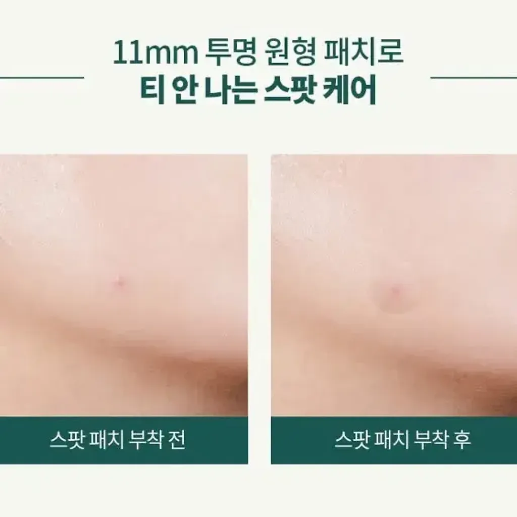 JuzBeauty_JuzBeautyMalaysia_JuzPretty_Authentic_Kbeauty_Malaysia_Skin_Care_Cosmetics_K-beauty_Health_Care_korean_streetwear_ACWIN Acne Patch 超薄隐形祛痘贴2