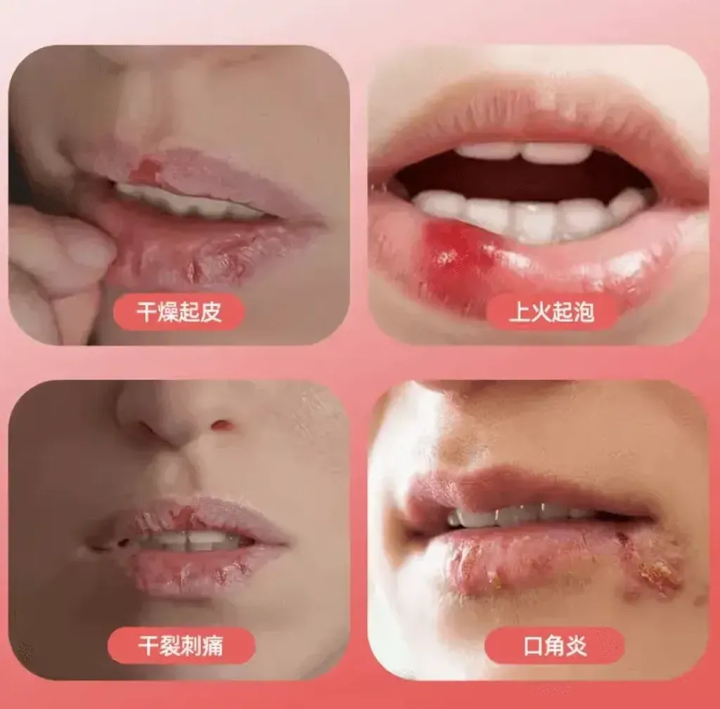 JuzBeauty_JuzBeautyMalaysia_JuzPretty_Authentic_Kbeauty_Malaysia_Skin_Care_Cosmetics_K-beauty_Health_Care_korean_streetwear_MORISHITA JINTAN MEDICARE Dental Pill Cream 森下仁丹消炎润唇膏5