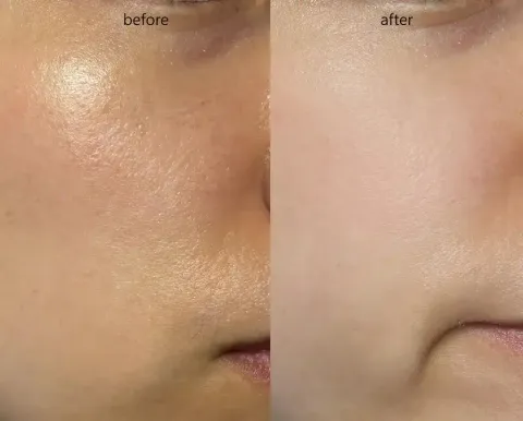 JuzBeauty_JuzBeautyMalaysia_JuzPretty_Authentic_Kbeauty_Malaysia_Skin_Care_Cosmetics_K-beauty_Health_Care_korean_streetwear_MEDITHERAPY Porethera Real Bifida Powder Serum 微毛孔益生菌粉末精华1