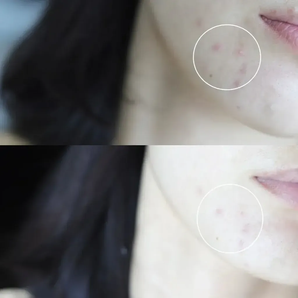 JuzBeauty_JuzBeautyMalaysia_JuzPretty_Authentic_Kbeauty_Malaysia_Skin_Care_Cosmetics_K-beauty_Health_Care_korean_streetwear_BRLAB Super Spot Remover Pro 净痘小蓝瓶精华Pro版 1