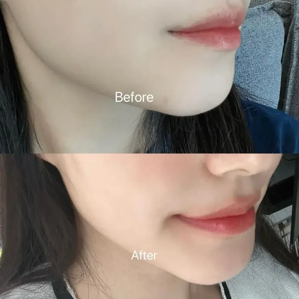 JuzBeauty_JuzBeautyMalaysia_JuzPretty_Authentic_Kbeauty_Malaysia_Skin_Care_Cosmetics_K-beauty_Health_Care_korean_streetwear_BRLAB Super Spot Remover Pro 净痘小蓝瓶精华Pro版 3