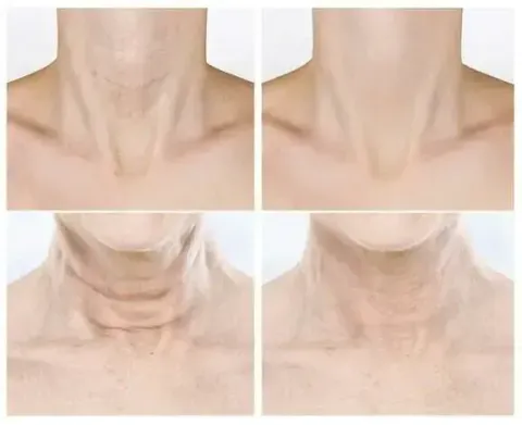 JuzBeauty_JuzBeautyMalaysia_JuzPretty_Authentic_Kbeauty_Malaysia_Skin_Care_Cosmetics_K-beauty_Health_Care_korean_streetwear_VELLA Neck Patch Prestige Wrinkle Free 5ea 深层抚纹熨斗颈膜3