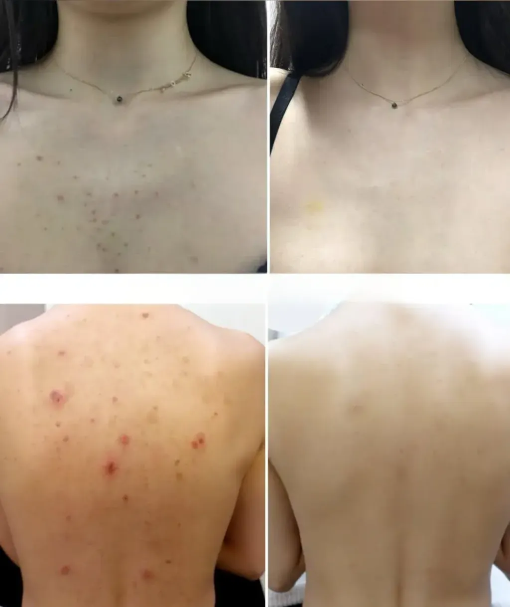 JuzBeauty_JuzBeautyMalaysia_JuzPretty_Authentic_Kbeauty_Malaysia_Skin_Care_Cosmetics_K-beauty_Health_Care_korean_streetwear_DONG-A PHARM Aclean Body Acne Care Treatment Spray DONGA 身体祛痘喷雾6