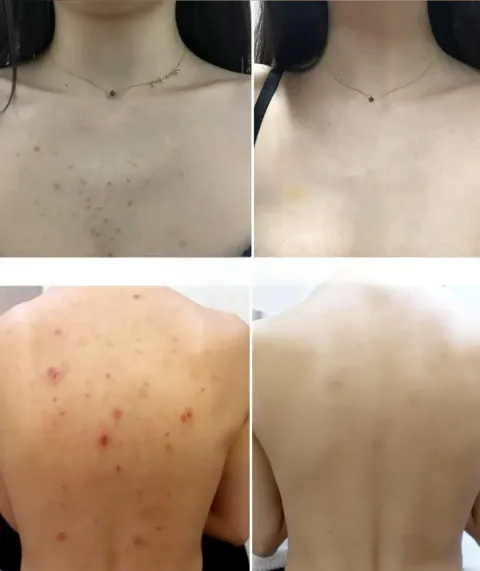 JuzBeauty_JuzBeautyMalaysia_JuzPretty_Authentic_Kbeauty_Malaysia_Skin_Care_Cosmetics_K-beauty_Health_Care_korean_streetwear_DONG-A PHARM Aclean Body Acne Care Treatment Spray DONGA 身体祛痘喷雾6