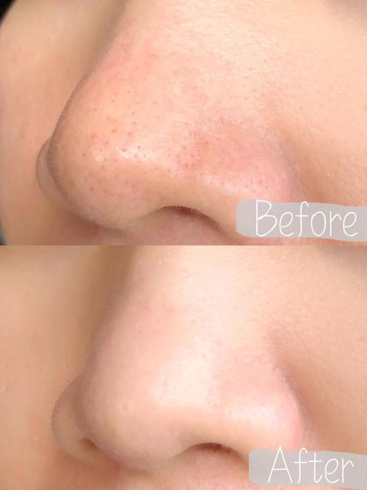 JuzBeauty_JuzBeautyMalaysia_Authentic_Kbeauty_RNW_Goodbye_Blackhead_Clear_Nose_Pack_4.jpg