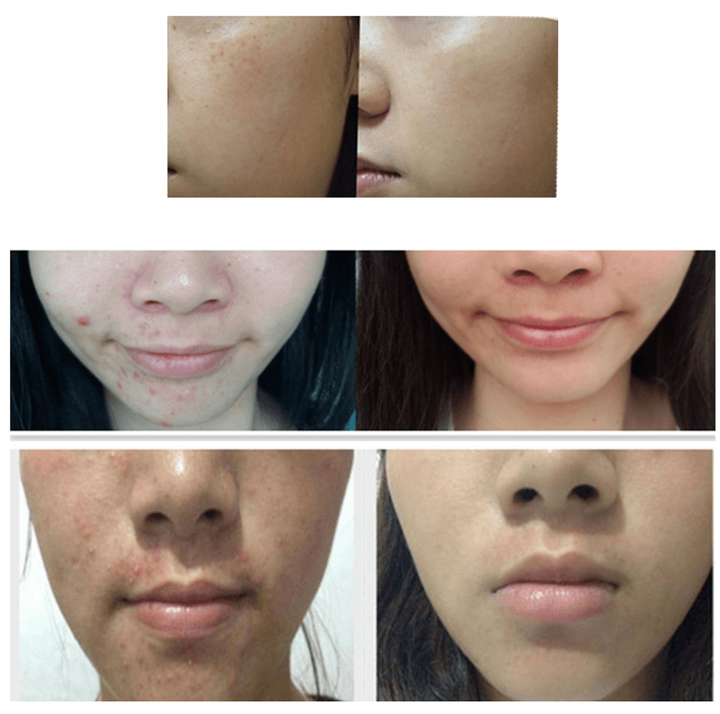 JuzBeauty_JuzBeautyMalaysia_JuzPretty_Authentic_Kbeauty_Malaysia_Jbeauty_Australia_Health_Care_Handok_ClearTeen_Acne_Solution_Treatment_ (1).png