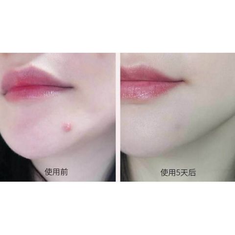 JuzBeauty_JuzBeautyMalaysia_JuzPretty_Authentic_Kbeauty_Malaysia_Skin_Care_Cosmetics_Jbeauty_Australia_Health_Care_IFPINA_Micro_Needle_Patch_ (4).jpg