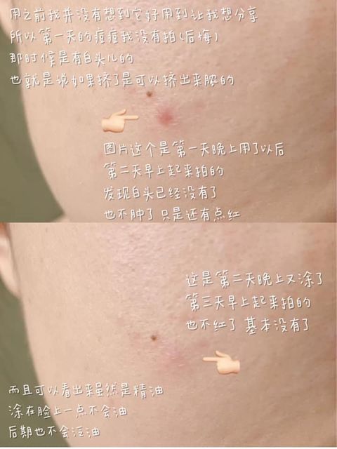 JuzBeauty_JuzBeautyMalaysia_JuzPretty_Authentic_Kbeauty_Malaysia_Skin_Care_Cosmetics_Jbeauty_Australia_Health_Care_FFLOW_Pick_Oil_Spot_Care_ (12).jpg