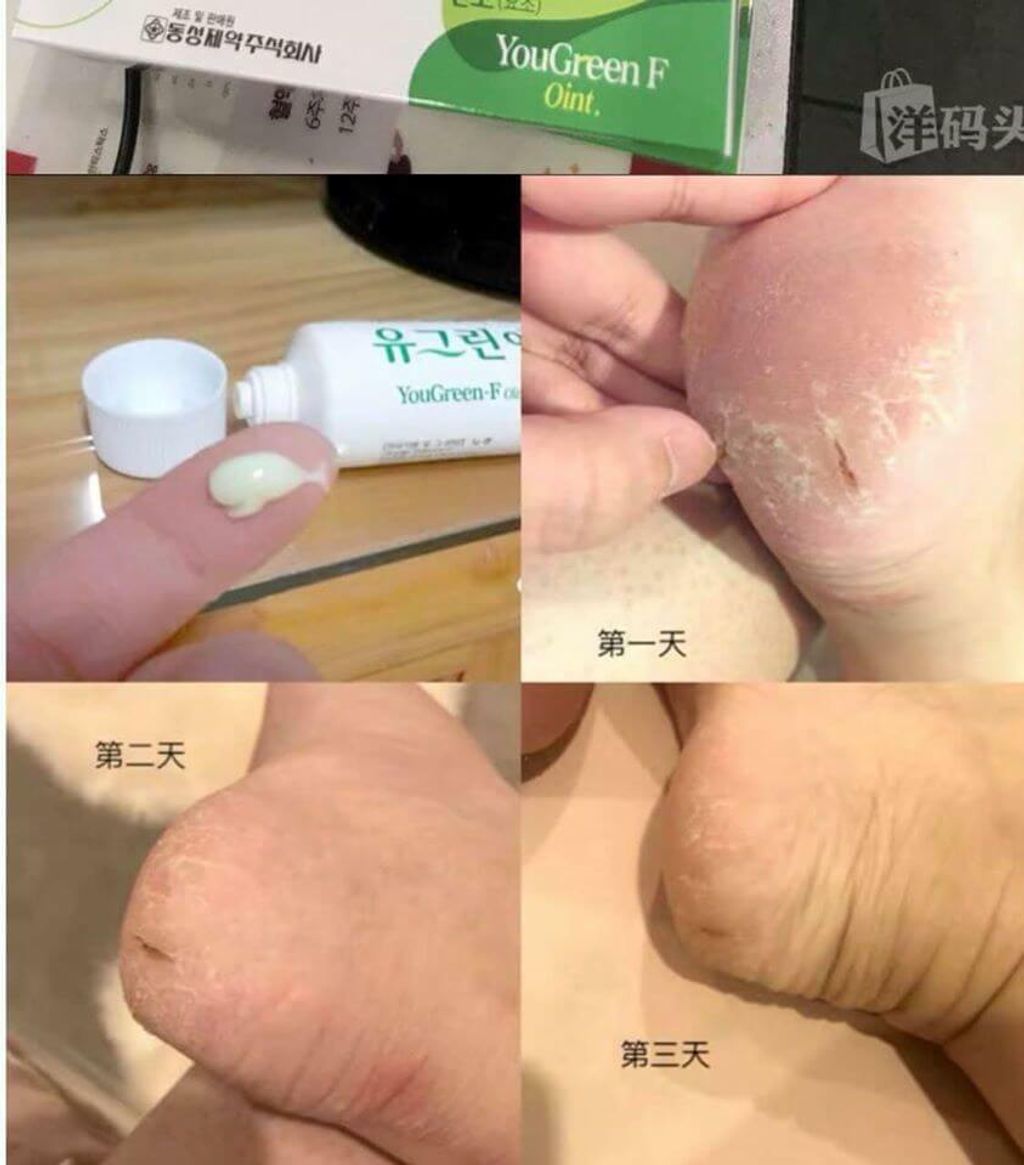 JuzBeauty_JuzBeautyMalaysia_JuzPretty_Authentic_Kbeauty_Malaysia_Skin_Care_Cosmetics_Jbeauty_Australia_Health_Care_korean_streetwear_Yougreen F Urea Foot & Heel Moisturizing Ointment 9