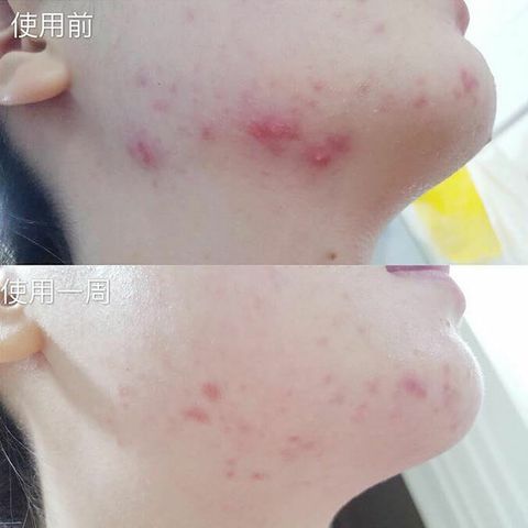 JuzBeauty_JuzBeautyMalaysia_JuzPretty_Authentic_Kbeauty_Malaysia_Skin_Care_Cosmetics_Jbeauty_Australia_Health_Care_korean_streetwear_isoi ACNI Dr 1st Control Tonic 7