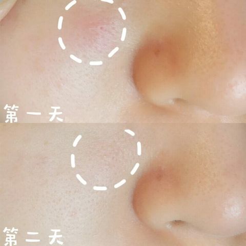 JuzBeauty-JuzBeautyMalaysia-JuzPretty-Authentic-Kbeauty-Malaysia-Skin-Care-Cosmetics-Jbeauty-Health-Care-korean-streetwear-ACROPASS Trouble Cure 微针修复痘痘贴7