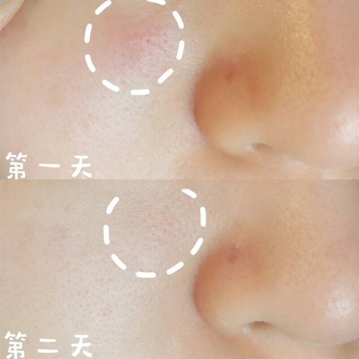 JuzBeauty-JuzBeautyMalaysia-JuzPretty-Authentic-Kbeauty-Malaysia-Skin-Care-Cosmetics-Jbeauty-Health-Care-korean-streetwear-ACROPASS Trouble Cure 微针修复痘痘贴7