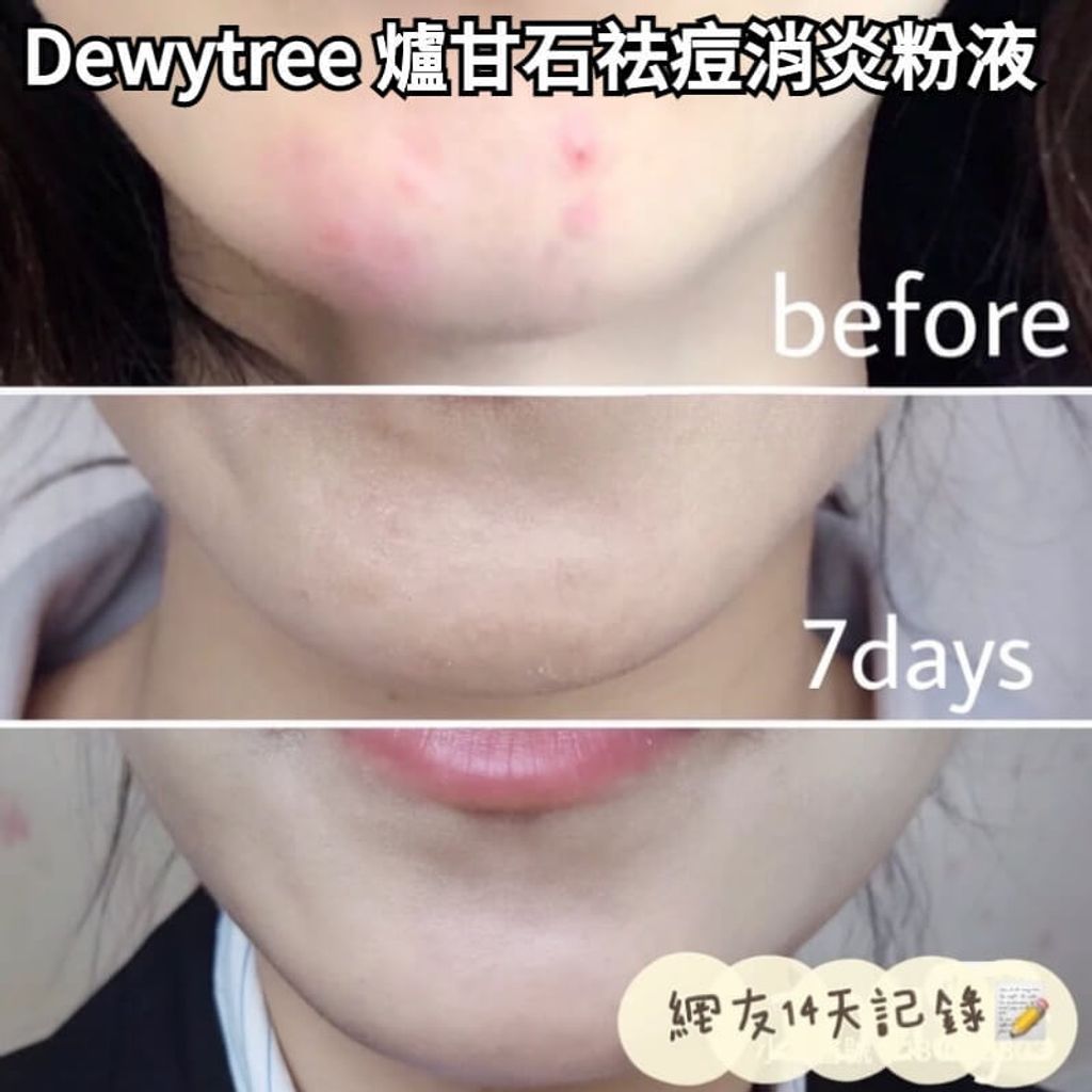 JuzBeauty-JuzBeautyMalaysia-JuzPretty-Authentic-Kbeauty-Malaysia-Skin-Care-Cosmetics-Jbeauty-Health-Care-korean-streetwear-olive-young-DEWYTREE The Clean Lab AC Dew Calamine Blemish Spot 炉甘石祛痘消炎粉液10