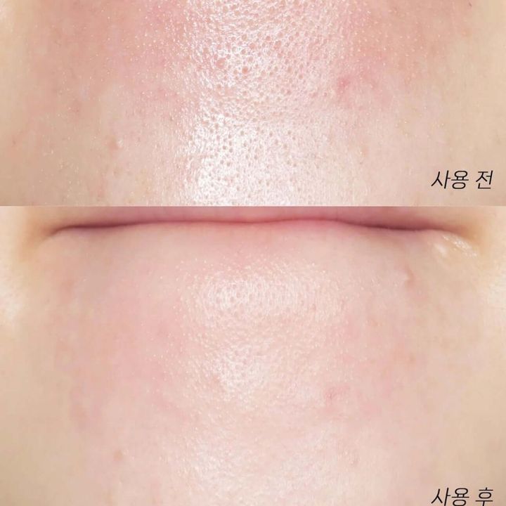 JuzBeauty-JuzBeautyMalaysia-JuzPretty-Authentic-Kbeauty-Malaysia-Skin-Care-Cosmetics-Jbeauty-Health-Care-korean-streetwear-Olive Young ILSO Super Melting Sebum Softener 黑头粉刺导出液5
