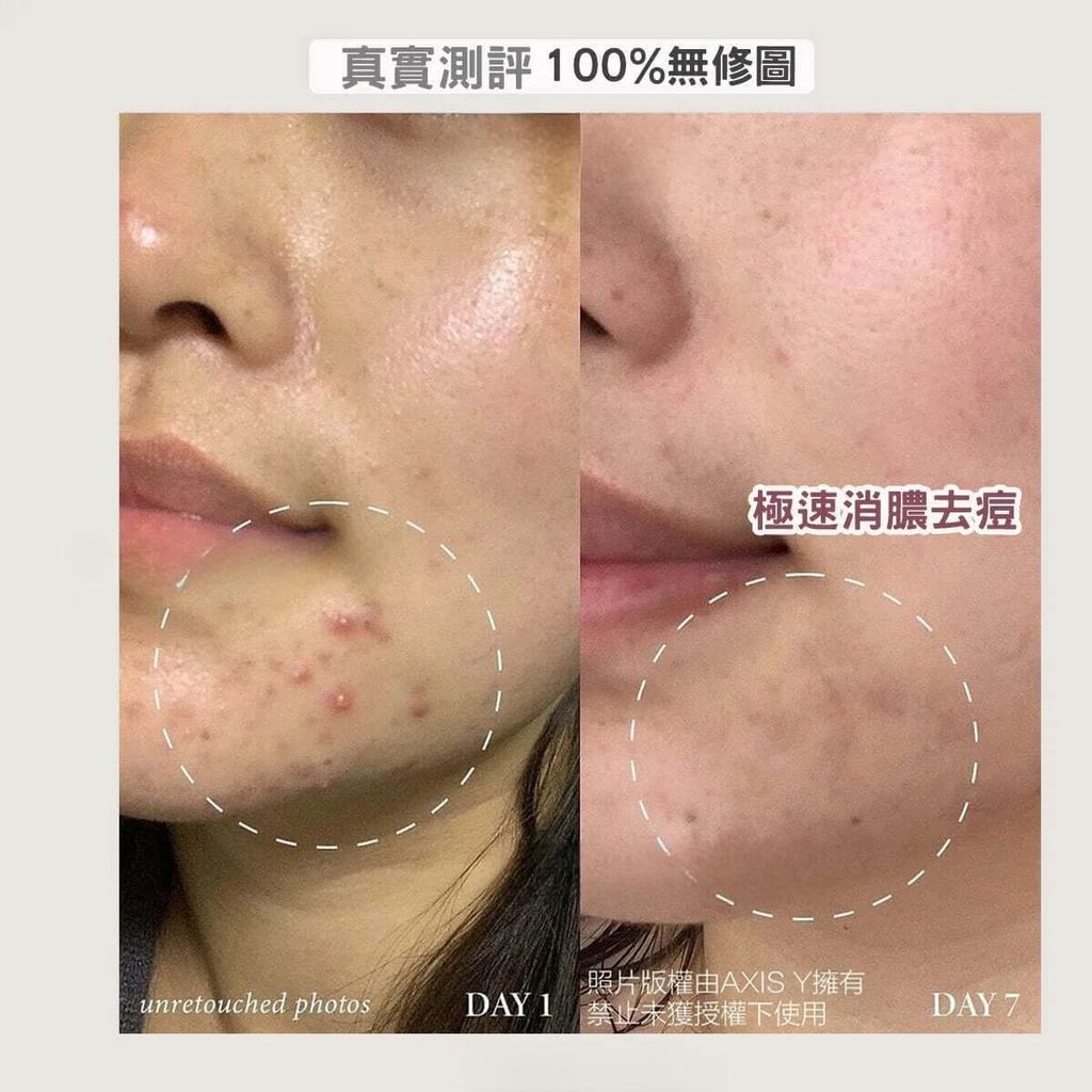 JuzBeauty-JuzBeautyMalaysia-JuzPretty-Authentic-Kbeauty-Malaysia-Skin-Care-Cosmetics-Jbeauty-Health-Care-korean-streetwear-Olive Young AXIS-Y Spot The Difference Blemish Treatment AxisY 小粉瓶祛痘精华8