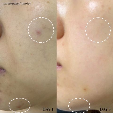 JuzBeauty-JuzBeautyMalaysia-JuzPretty-Authentic-Kbeauty-Malaysia-Skin-Care-Cosmetics-Jbeauty-Health-Care-korean-streetwear-Olive Young AXIS-Y Spot The Difference Blemish Treatment AxisY 小粉瓶祛痘精华2