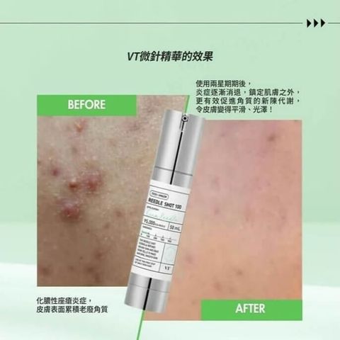 JuzBeauty-JuzBeautyMalaysia-JuzPretty-Authentic-Kbeauty-Malaysia-Skin-Care-Cosmetics-Jbeauty-Health-Care-korean-streetwear-Olive-Young-VT Reedle Shot 100 积雪草改善毛孔100微针精华3