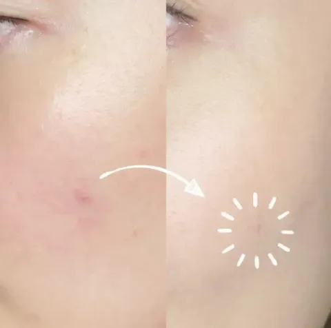 JuzBeauty-JuzBeautyMalaysia-JuzPretty-Authentic-Kbeauty-Malaysia-Skin-Care-Cosmetics-Jbeauty-Health-Care-korean-streetwear-Olive-Young-CAREPLUS Trouble Patch 微针超薄痘痘贴7