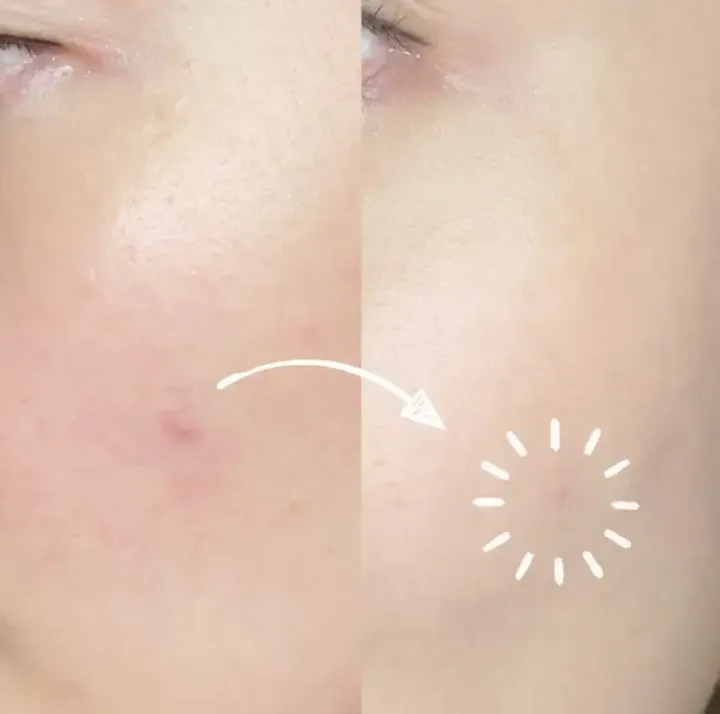JuzBeauty-JuzBeautyMalaysia-JuzPretty-Authentic-Kbeauty-Malaysia-Skin-Care-Cosmetics-Jbeauty-Health-Care-korean-streetwear-Olive-Young-CAREPLUS Trouble Patch 微针超薄痘痘贴7