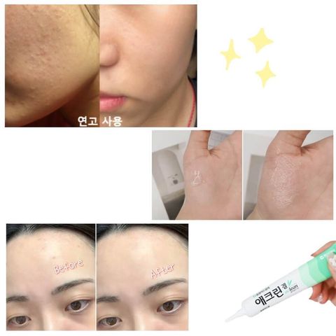 JuzBeauty-JuzBeautyMalaysia-JuzPretty-Authentic-Kbeauty-Malaysia-Skin-Care-Cosmetics-Jbeauty-Health-Care-korean-streetwear-DONG-A PHARM Aclean Gel 水杨酸凝胶1
