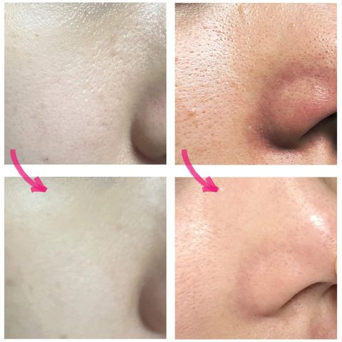 JuzBeauty-JuzBeautyMalaysia-JuzPretty-Authentic-Kbeauty-Malaysia-Skin-Care-Cosmetics-Jbeauty-Health-Care-korean-streetwear-Olive-Young-MEDITHERAPY Porethera Shot Exosome Spicule Serum FREE Device 毛孔藻针精华 美容仪