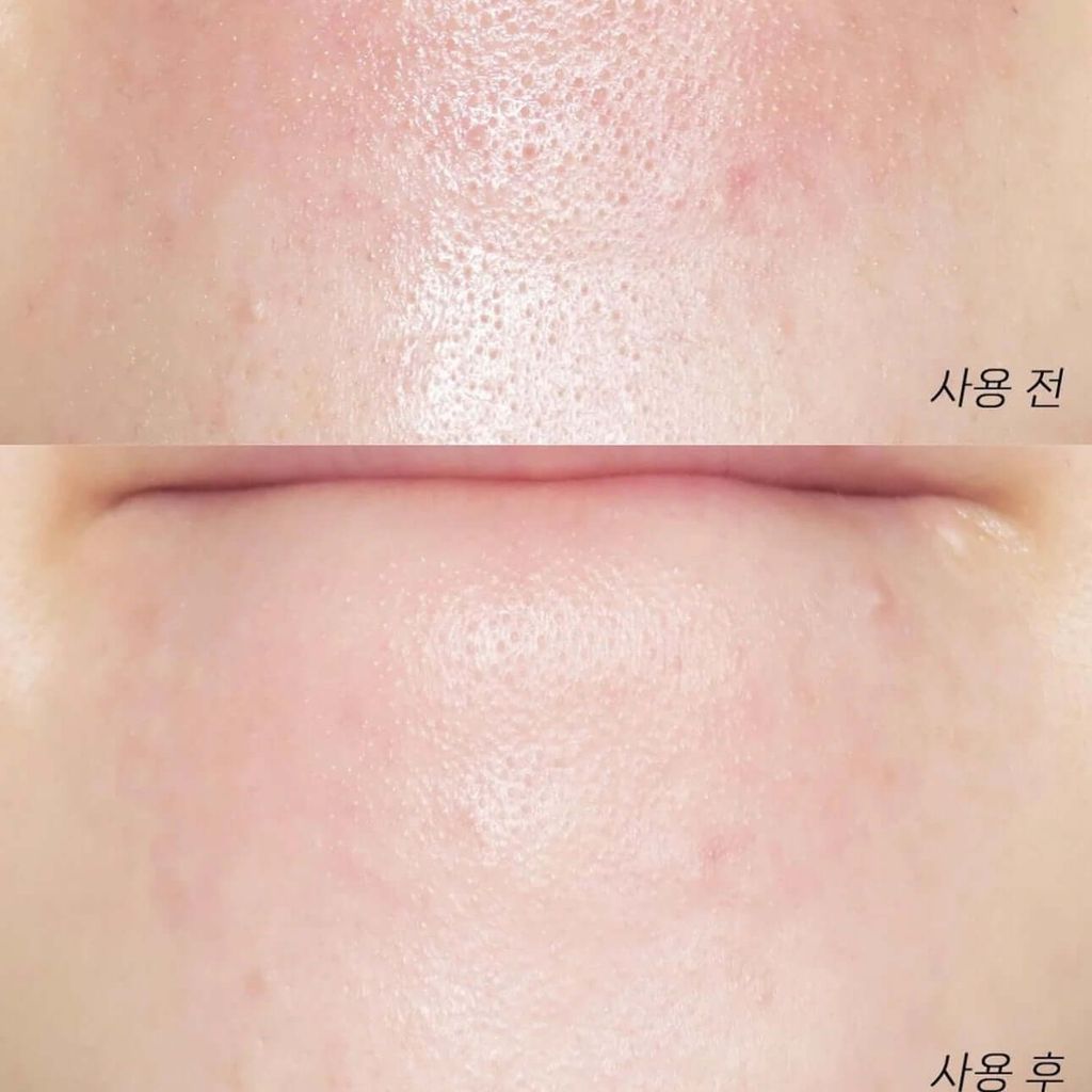 JuzBeauty-JuzBeautyMalaysia-JuzPretty-Authentic-Kbeauty-Malaysia-Skin-Care-Cosmetics-Jbeauty-Health-Care-korean-streetwear-Olive Young ILSO Deep Clean Master 不锈钢深清刮刮黑头铲2