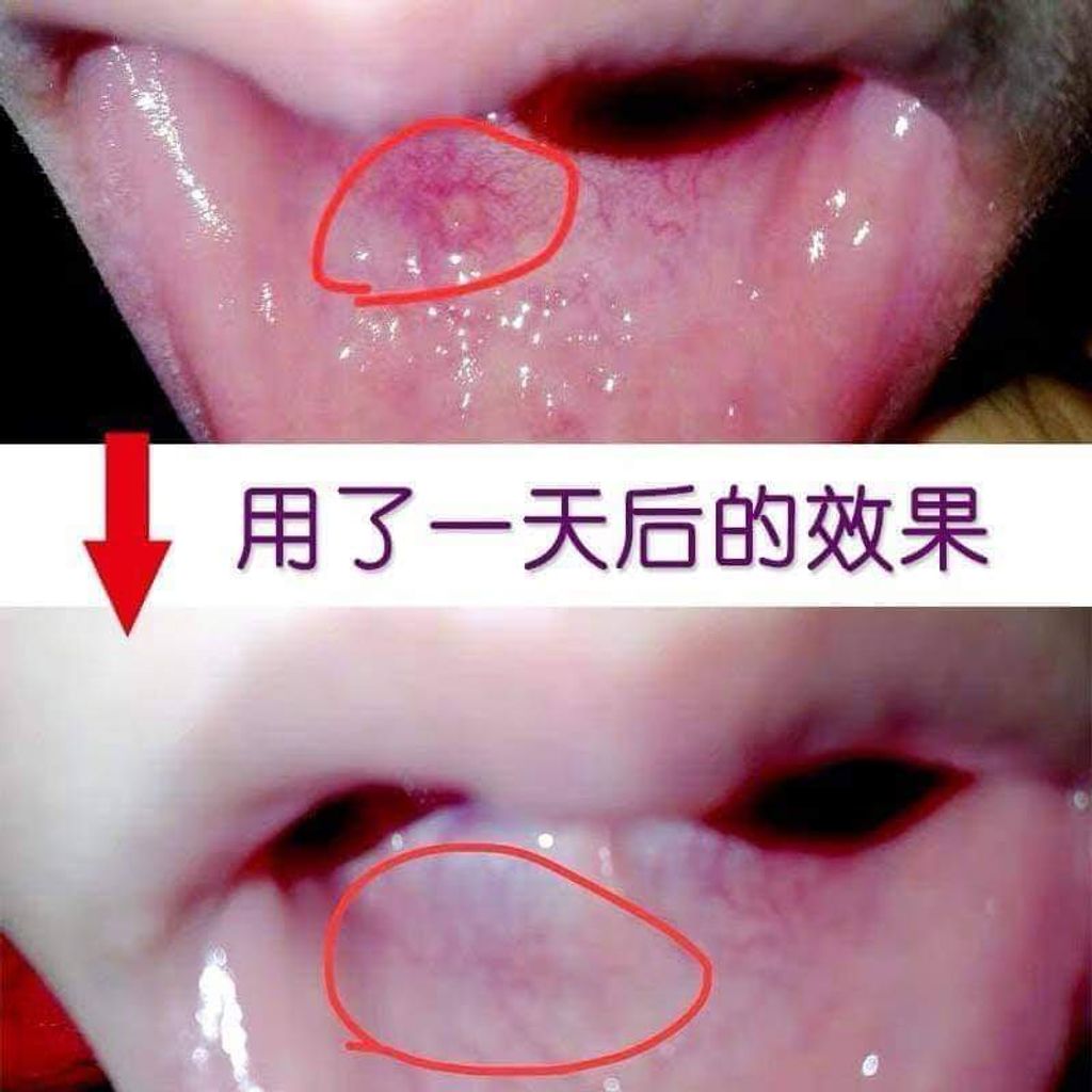 JuzBeauty-JuzBeautyMalaysia-JuzPretty-Authentic-Kbeauty-Malaysia-Skin-Care-Cosmetics-Jbeauty-Health-Care-korean-streetwear-GC Peridex Ointment for the Oral Cavity Disease 口腔溃疡膏11