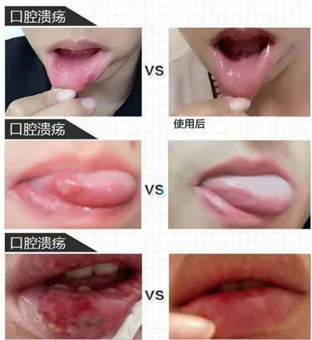 JuzBeauty-JuzBeautyMalaysia-JuzPretty-Authentic-Kbeauty-Malaysia-Skin-Care-Cosmetics-Jbeauty-Health-Care-korean-streetwear-GC Peridex Ointment for the Oral Cavity Disease 口腔溃疡膏1