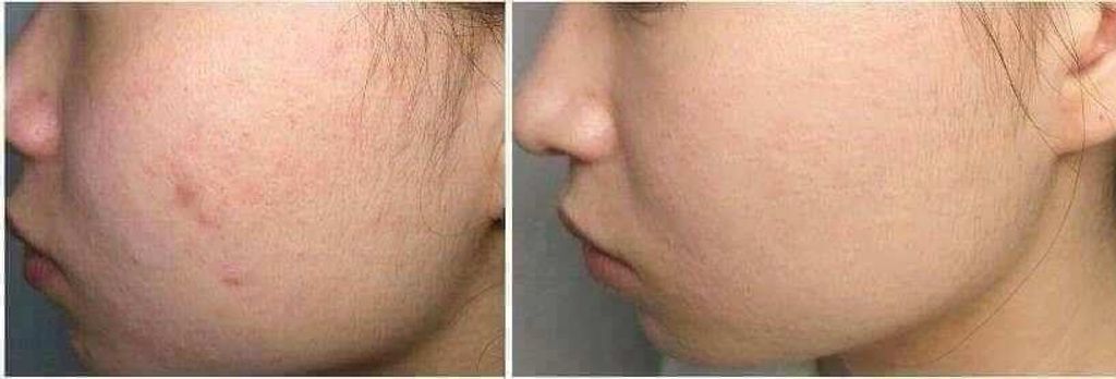 JuzBeauty_JuzBeautyMalaysia_JuzPretty_Authentic_Kbeauty_Malaysia_Skin_Care_Cosmetics_Jbeauty_Australia_Health_Care_Merphil_AC_Magic_Cleanser_ (2).jpg