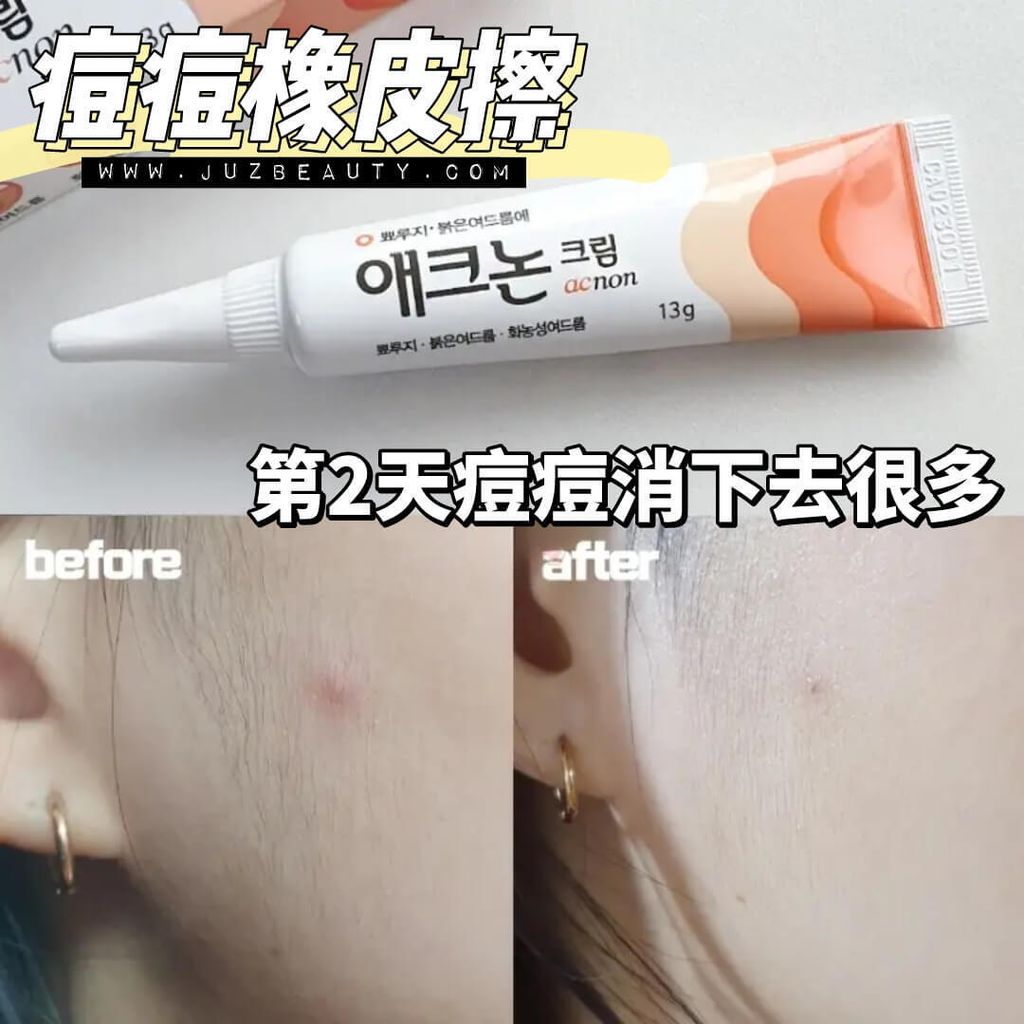 JuzBeauty-JuzBeautyMalaysia-JuzPretty-Authentic-Kbeauty-Malaysia-Skin-Care-Cosmetics-Jbeauty-Health-Care-korean-streetwear-DONG-A PHARM Acnon Cream 东亚制药祛痘膏2