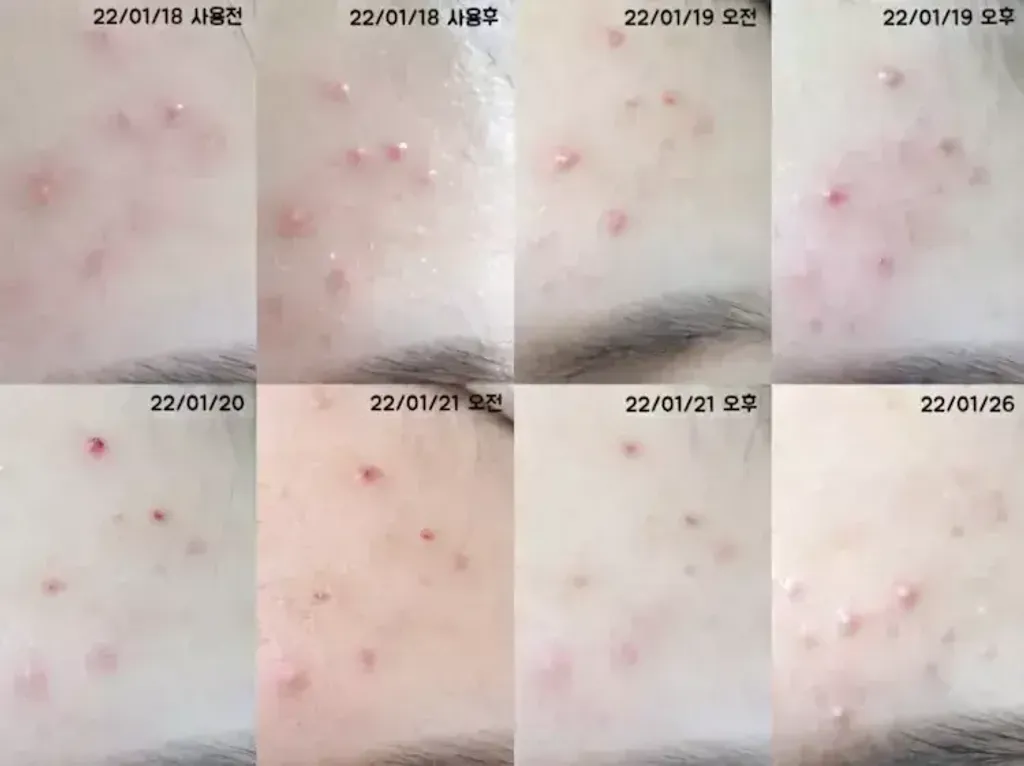 JuzBeauty-JuzBeautyMalaysia-JuzPretty-Authentic-Kbeauty-Malaysia-Skin-Care-Cosmetics-Jbeauty-Health-Care-korean-streetwear-DONG-A PHARM Acnon Cream 东亚制药祛痘膏5