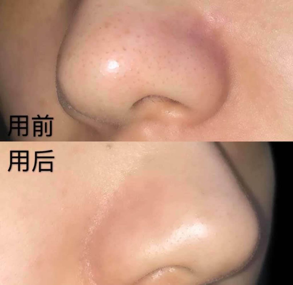 JuzBeauty_JuzBeautyMalaysia_JuzPretty_Authentic_Kbeauty_Malaysia_Jbeauty_Australia_Health_Care_CNP_Laboratory_Anti-pore_Black_Head_Clear_Kit_ (11).jpg