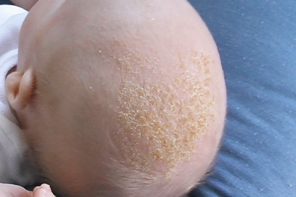 Seborrheic-Eczema-Dermatitis-Cradle-Cap.jpg