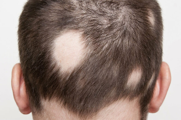 Alopecia-Areata.jpg