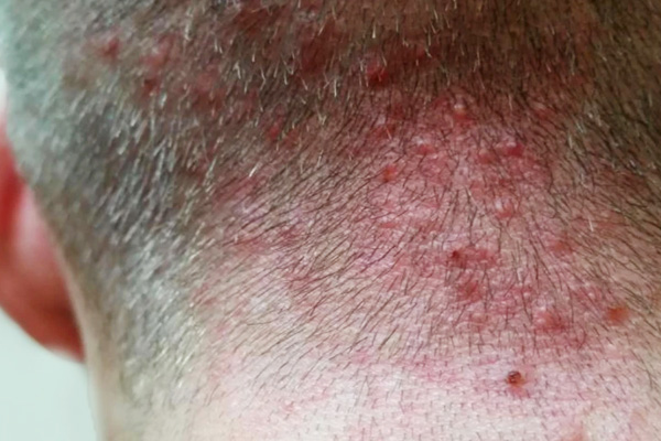 Folliculitis.jpg