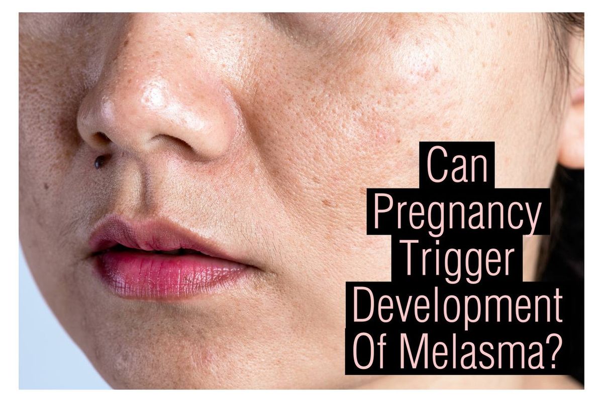 Pregnancy Can Trigger Melasma?