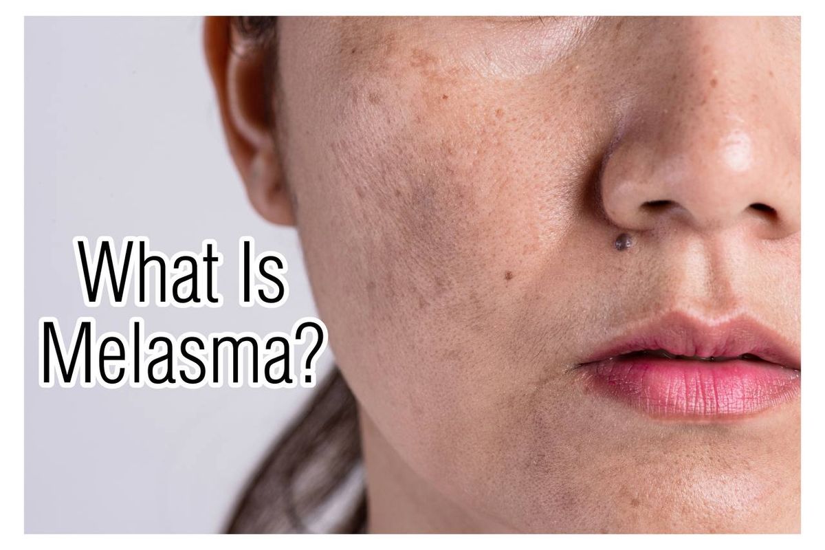 What is Melasma?