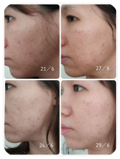 May I ask why do some people experience more itchiness or breakouts of acne after using certain products?