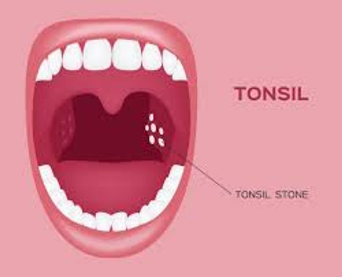 Cara Merawat Tonsil