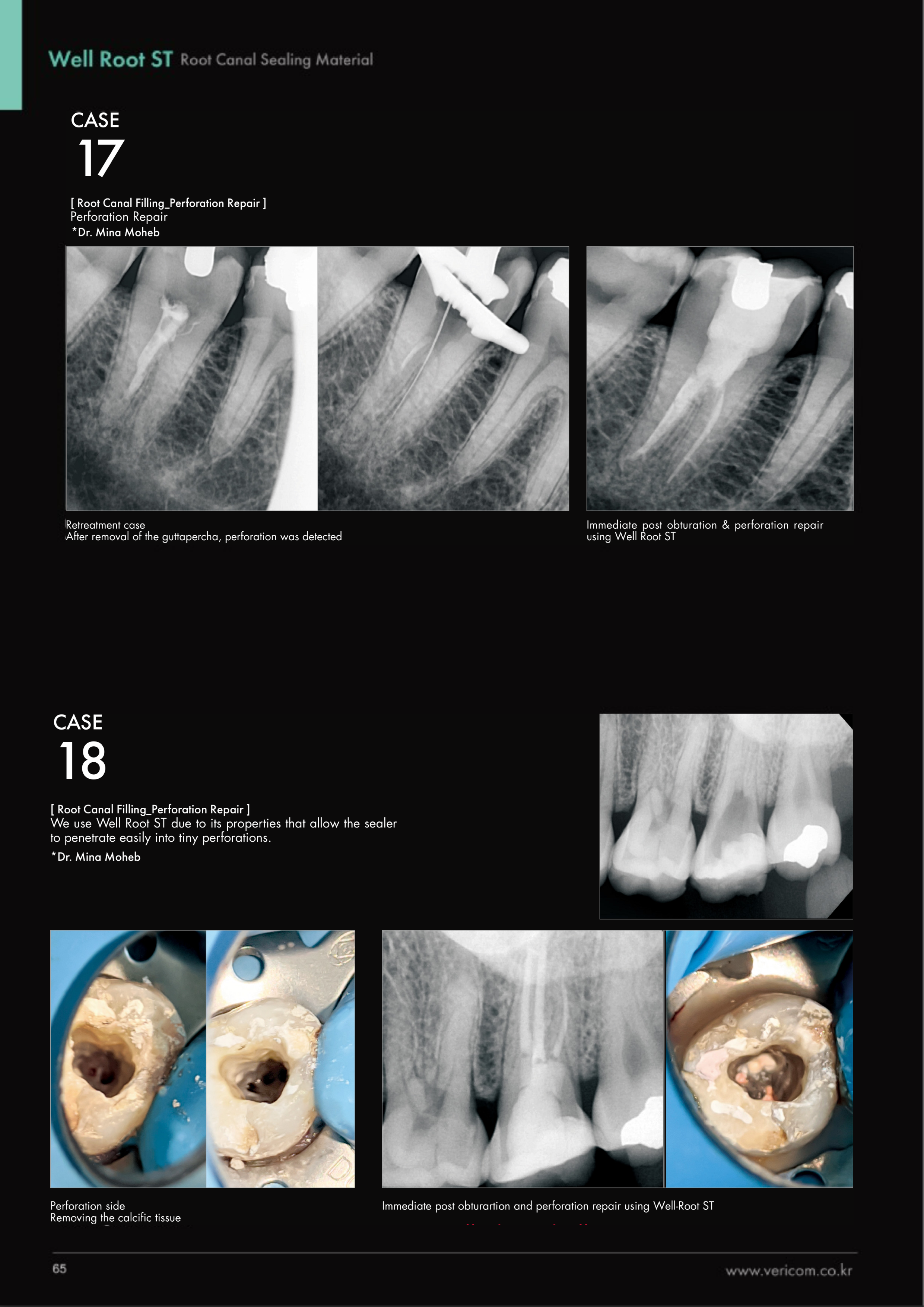 W-Root ST  CASE Book-17