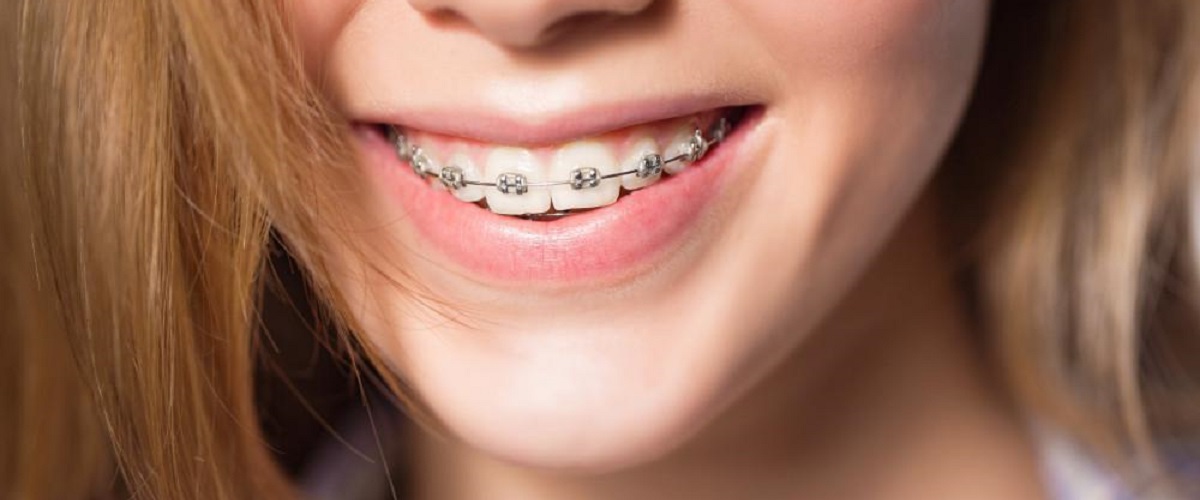 JSI Global |  - Orthodontics